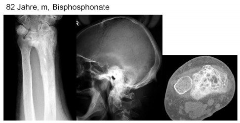 Morbus Paget Tumororthopaedie